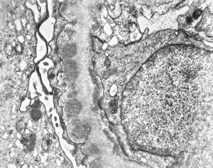 F,28y. | type III membranoproliferative glomerulonephritis F,28y. | type III membranoproliferative glomerulonephritis
